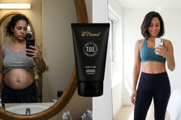 Creme TOE Funciona Mesmo Meu Antes e Depois com Estrias Profundas