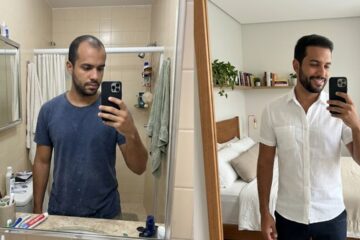 Trinoxidil Caps Funciona Mesmo Meu Antes e Depois Contra a Calvície Masculina